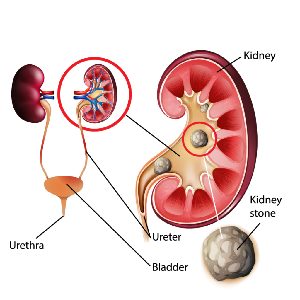 Stone-Free Eating: A Nutritional Approach to Preventing Kidney Stones