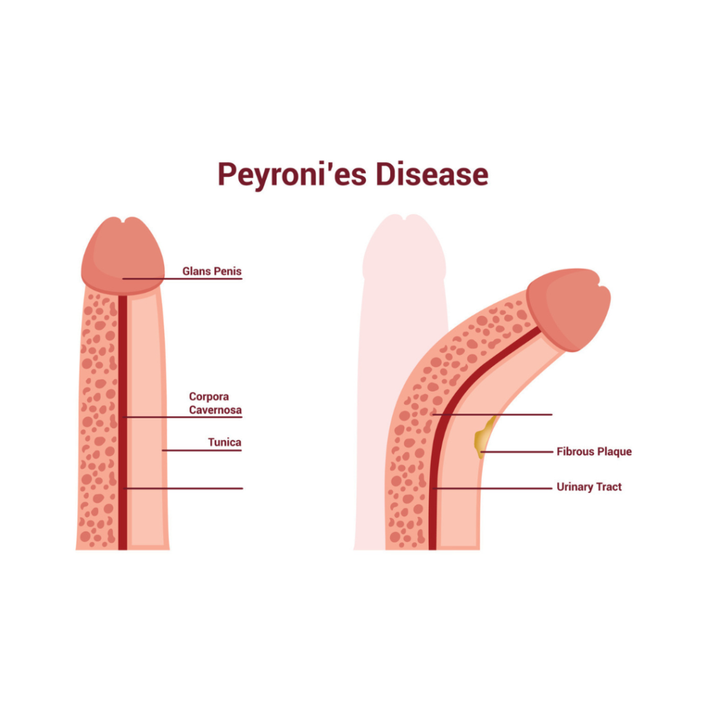 Understanding Peyronie’s Disease: Causes, Symptoms, and Treatment Options
