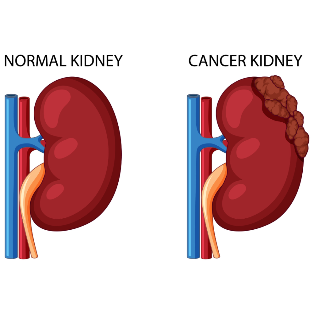 Early Symptoms & Warning Signs Of Kidney Cancer