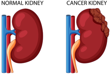 kidney cancer