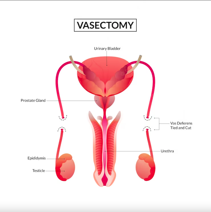Vasectomy: All You Should Know About it