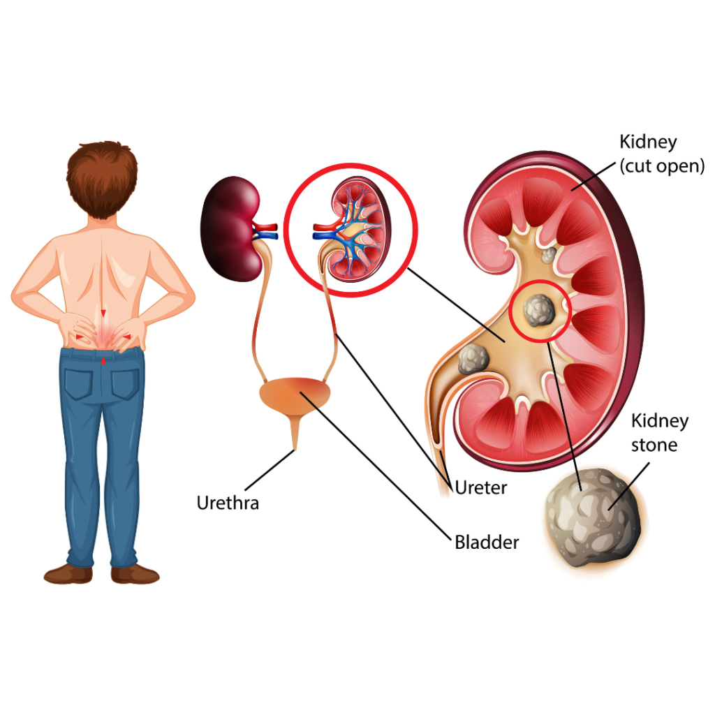 5 Habits That Put You at Greater Risk for Kidney Stones