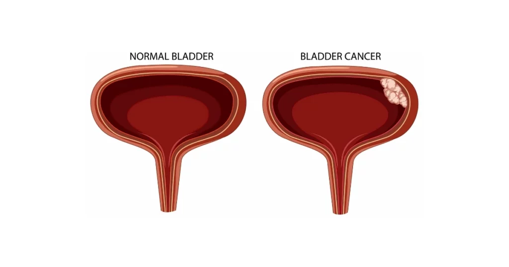 The Warning Signs of Bladder Cancer
