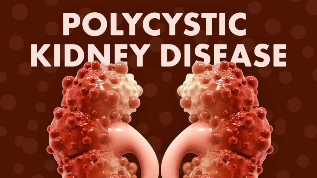 Polycystic Kidney Disease (PKD) – Symptoms, Causes, Treatment