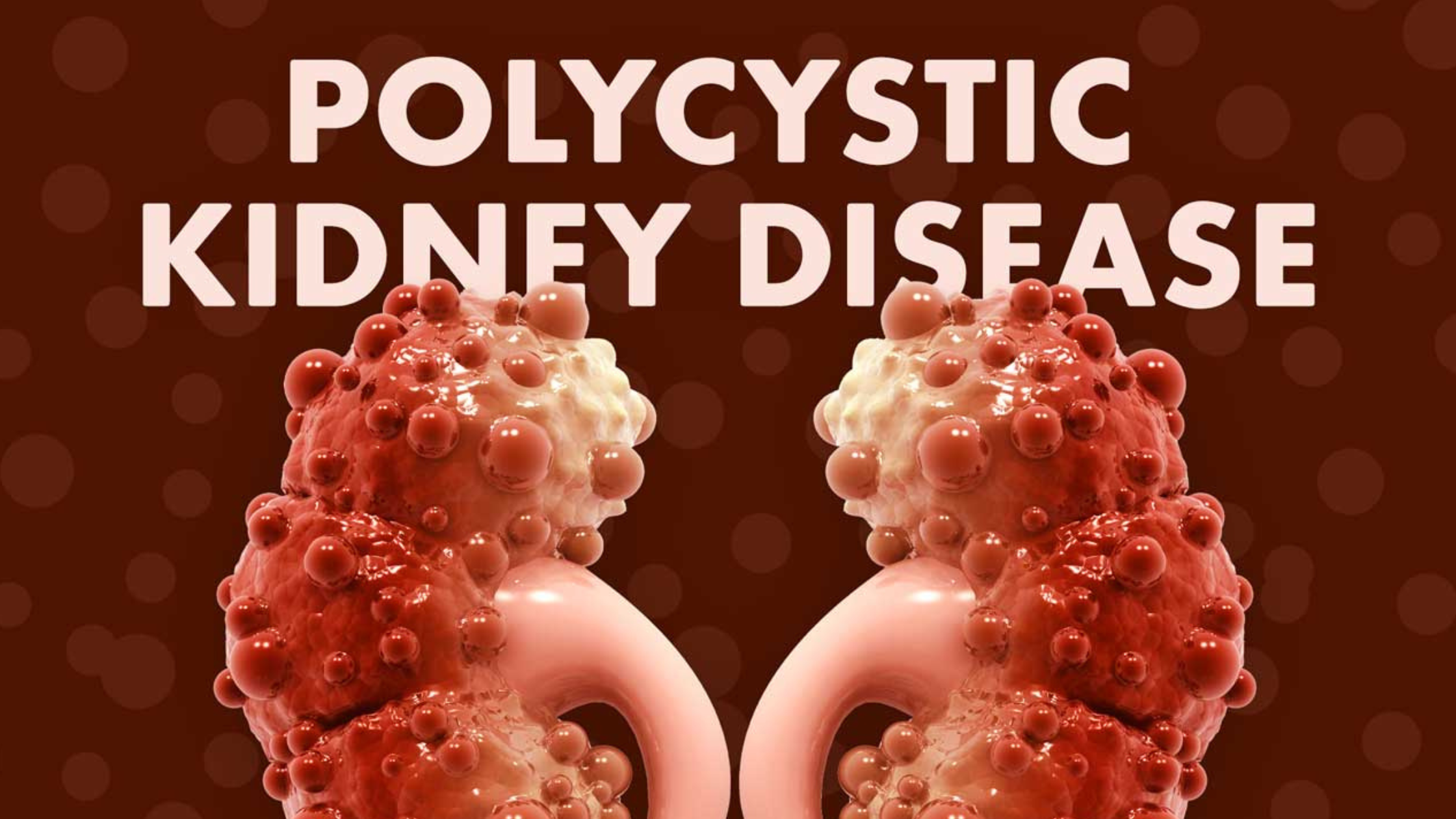 polycystic kidney disease