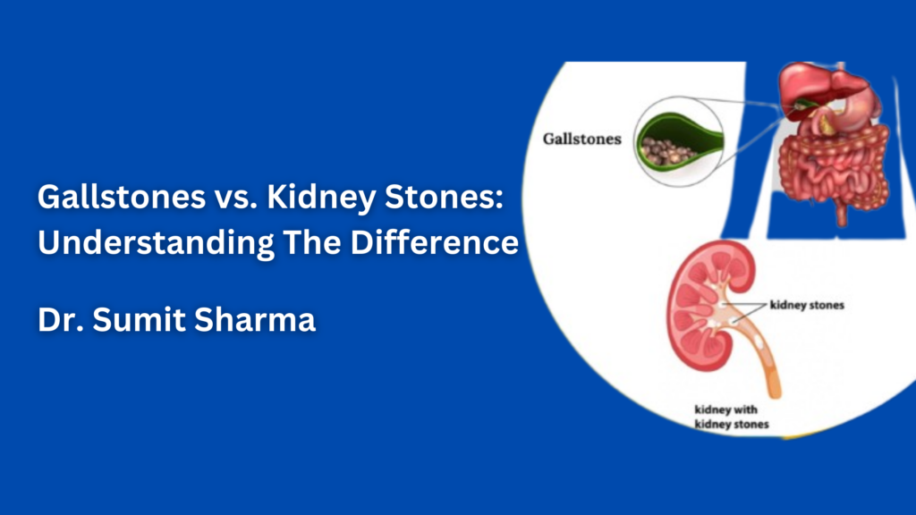 Gallstones vs. Kidney Stones: Understanding The Difference