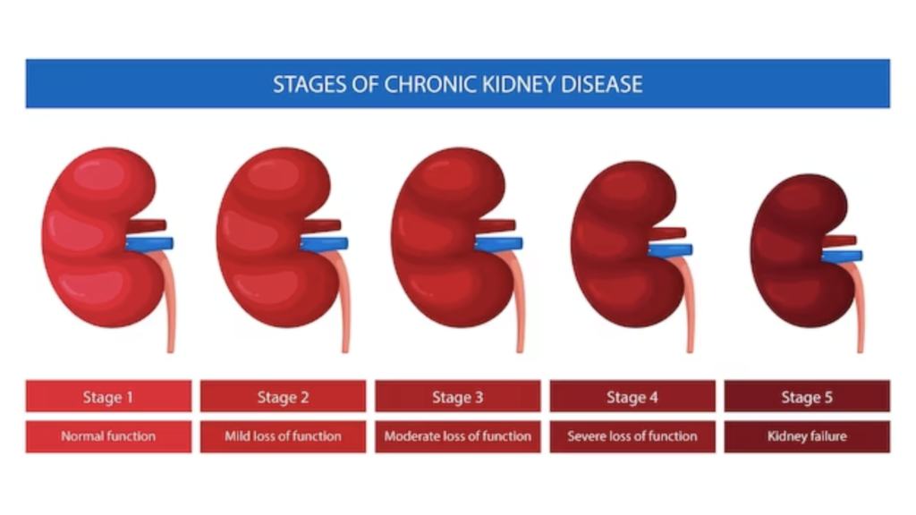 Understanding the Stages of Chronic Kidney Disease (CKD)
