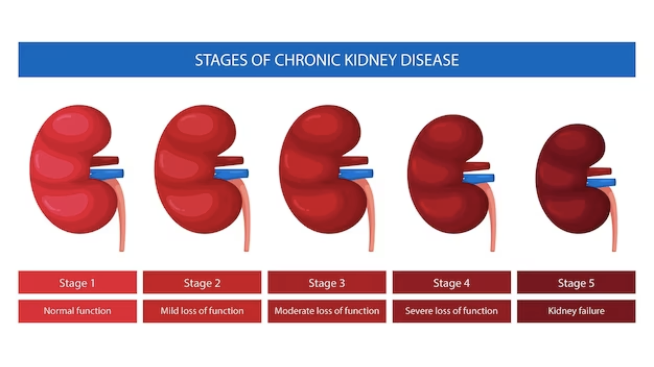 stages of chronic kidney disease