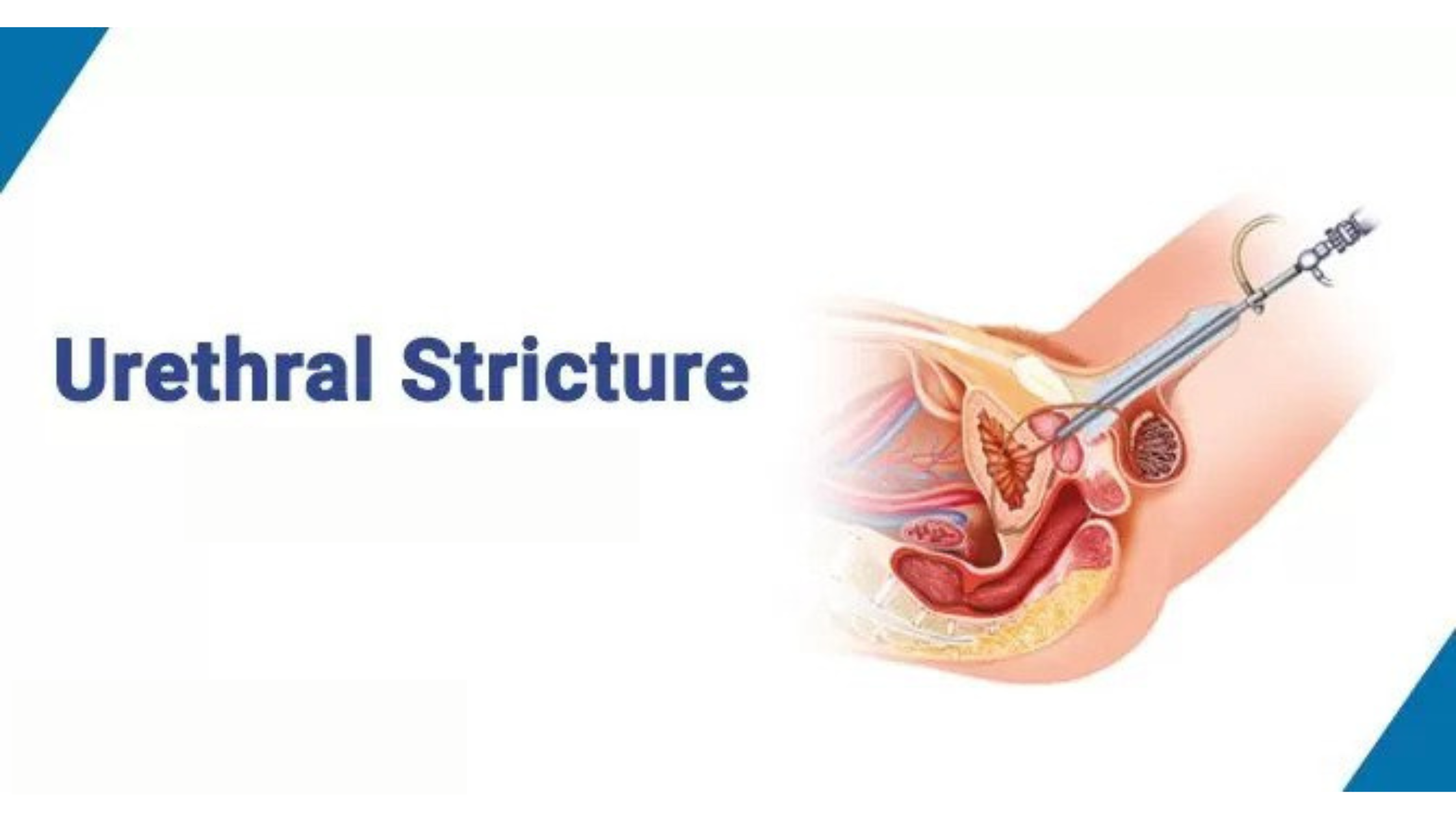 Urethral stricture