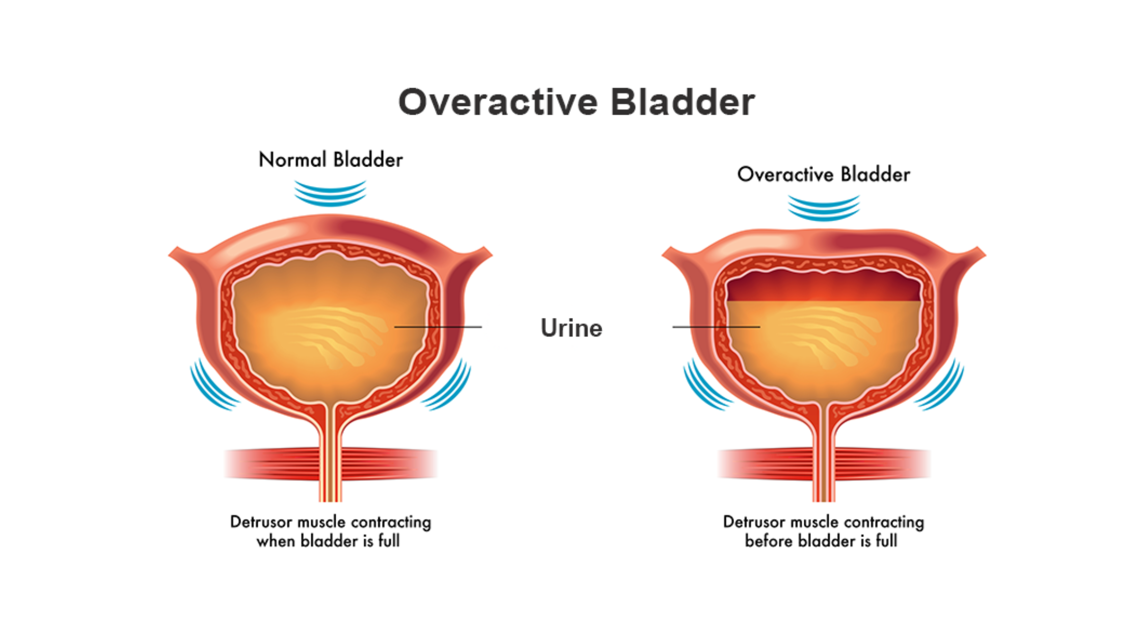Overactive Bladder (OAB): Causes, Symptoms & Treatment