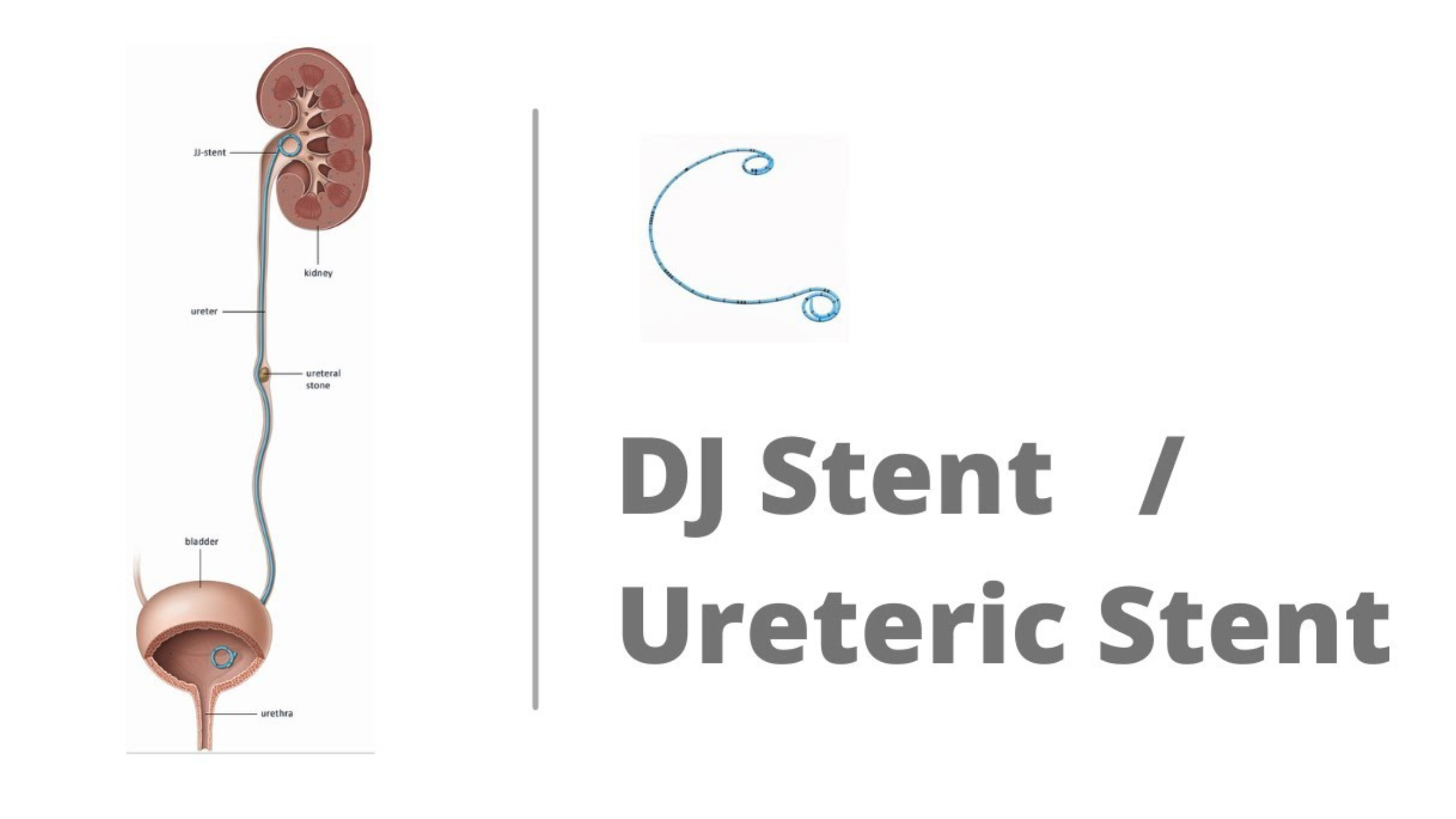 DJ stent