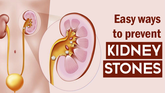 Diet and Lifestyle Tips to Prevent Kidney Stones