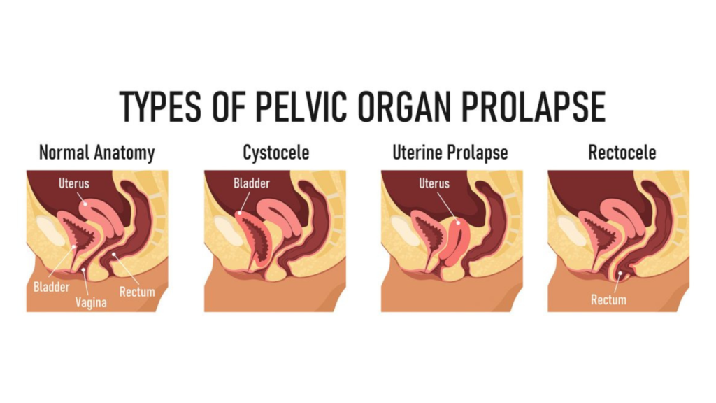 The Connection Between Pelvic Organ Prolapse and Sexual Dysfunction