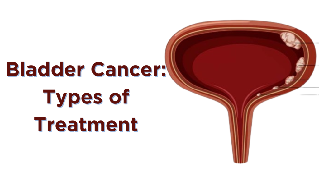 Bladder Cancer: Types of Treatment